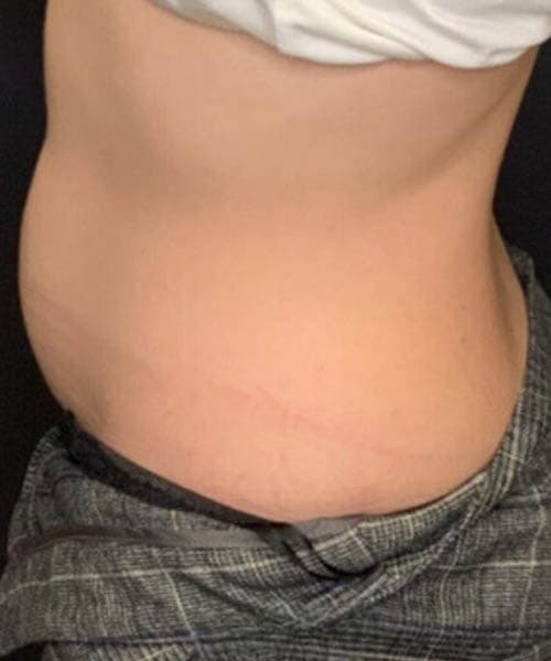 Before fat freezing treatment 7