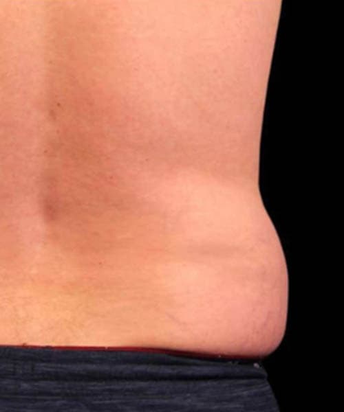 Before fat freezing treatment 8