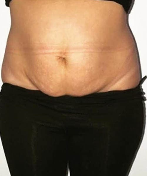 Before fat freezing treatment 9