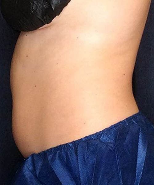 Before fat freezing treatment 2