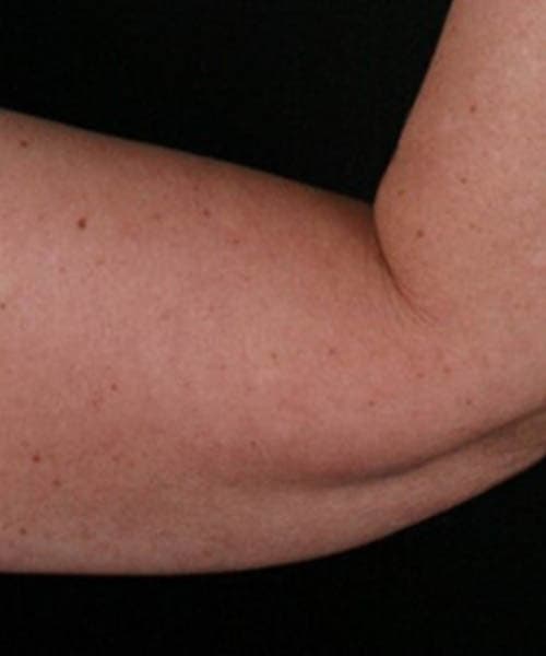 Before fat freezing treatment 3