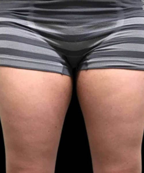 Before fat freezing treatment 5