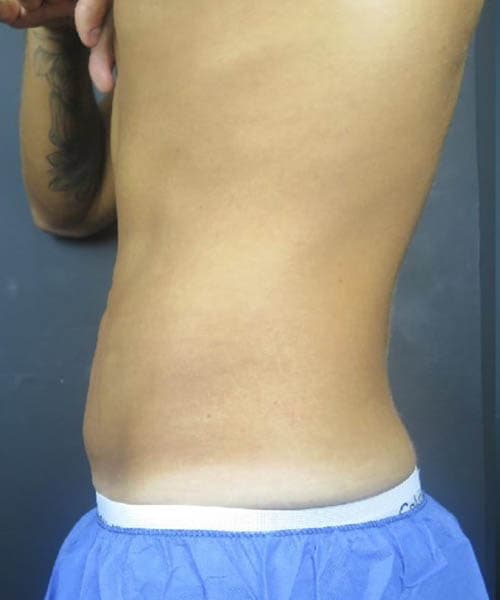 Before fat freezing treatment 1