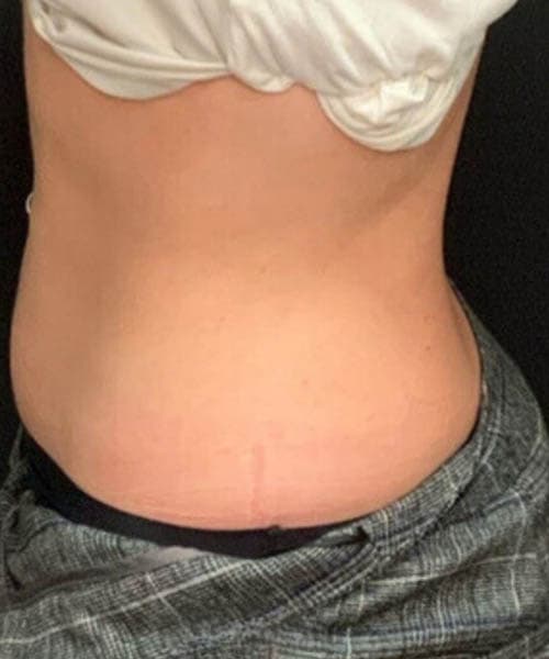 After fat freezing treatment 7