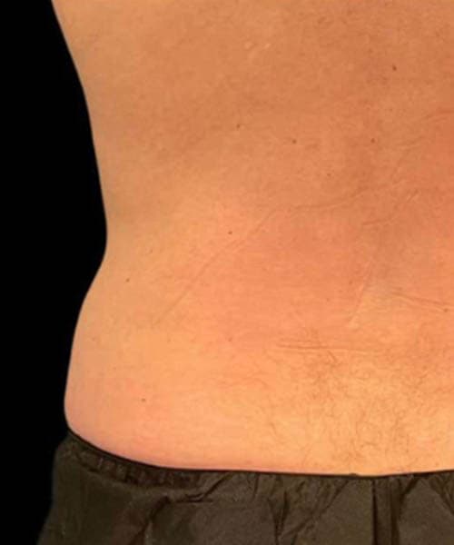 After fat freezing treatment 8