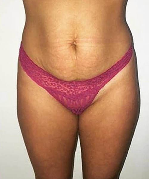 After fat freezing treatment 9