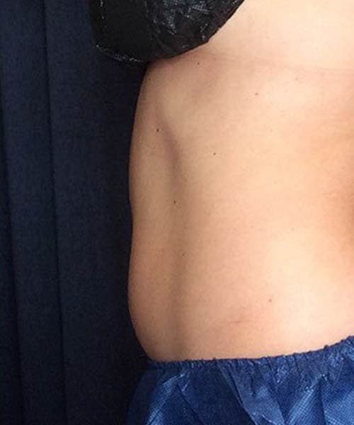 After fat freezing treatment 2