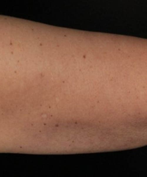 After fat freezing treatment 3