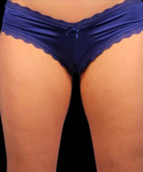 After fat freezing treatment 5