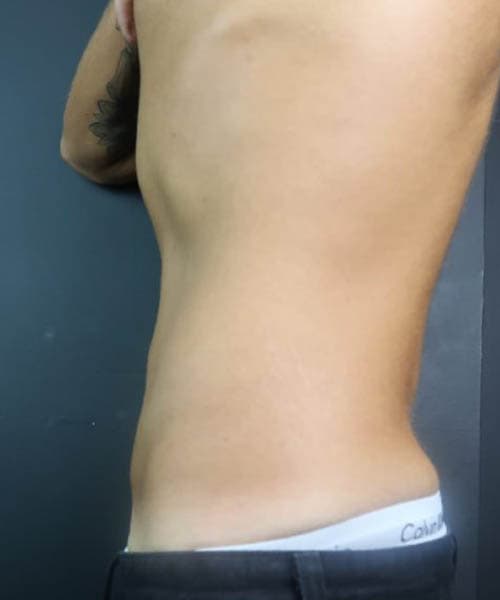 After fat freezing treatment 1